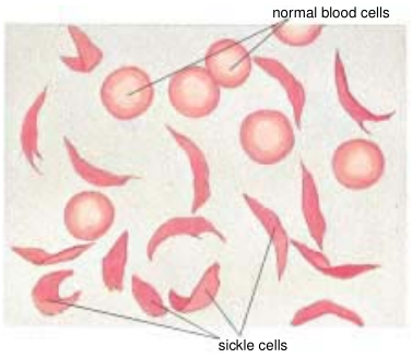 Sickling of red blood cells red blood cells
