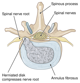 herniated disk
