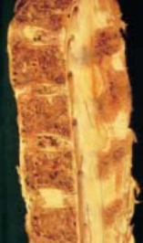 ankylosis