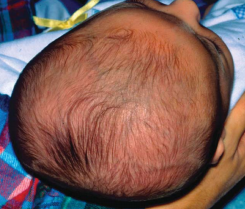 Careful assessment may reveal plagiocephaly.png Careful assessment may reveal plagiocephaly.png
