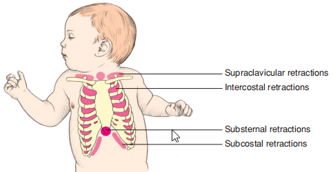 Anatomic locations of retractions.png