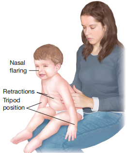 A child in respiratory distress.png A child in respiratory distress.png