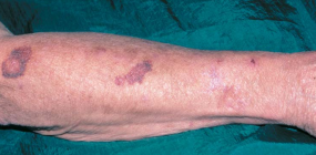 Actinic purpura on forearm.png Actinic purpura on forearm.png