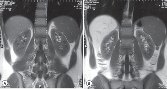 MRI of the upper abdomen before and after administration of manganese.