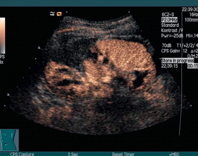 Ultrasound image of a kidney
