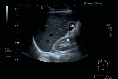 Congested liver