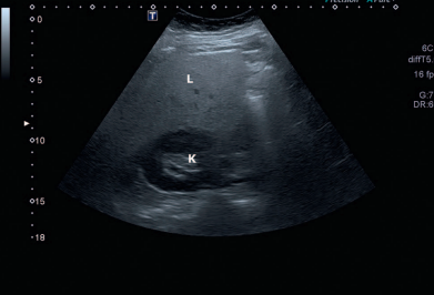 Fatty liver