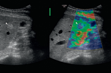 The echogenic lesion in the left pane has the appearances of a haemangioma