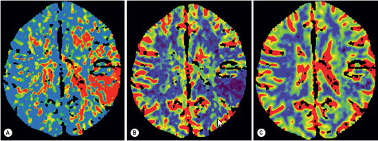 Perfusion CT in left middle cerebral artery territory infarct