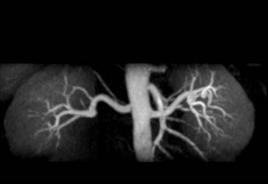 Non-contrast-enhanced MRA of the renal arteries