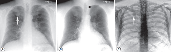 Series of dual-energy subtraction chest radiographs in a healthy man