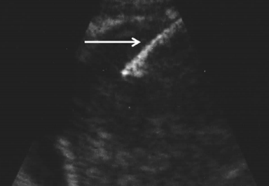 The needle is visualised as a linear focus of high echoreflectivity.