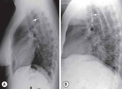 Lateral view of trachea and major bronchi.