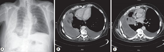Chest X-ray shows an encapsulated pleural effusion on the right