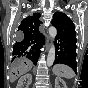Malignant pleural thickening was caused by pleural metastases.