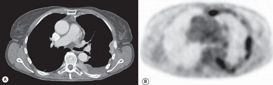 FDG-PET CT of a patient with malignant mesothelioma.