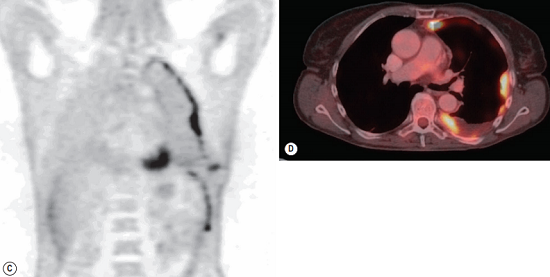 FDG-PET CT of a patient with malignant mesothelioma.