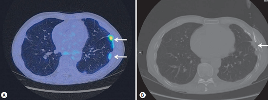 PET-CT performed in a patient with suspected malignant pleural thickening
