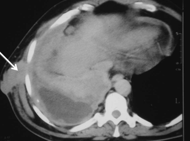 CT, demonstrating mesothelioma growing