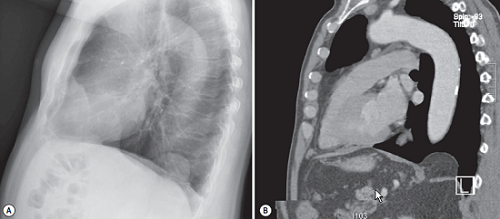 Lateral chest radiograph shows a focal bulge on the diaphragmatic contour