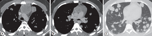Chest CT demonstrates an anterior mediastinal mass
