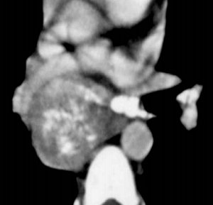 High-attenuation lymph nodes.