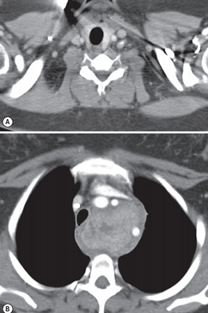 Transaxial CT images show a normal thyroid
