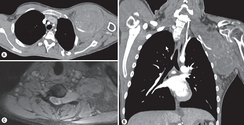 Malignant nerve sheath tumour