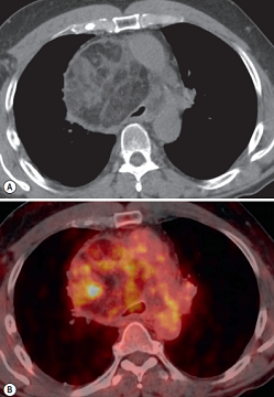 Angiomyolipoma and myelolipoma are both benign tumours