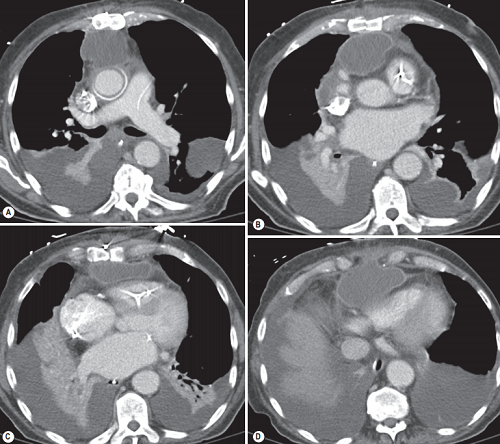 Mediastinal abscess
