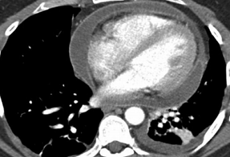 The most common imaging manifestation of acute pericarditis is a pericardial effusion