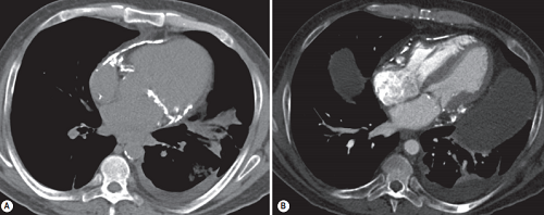 Constrictive pericarditis