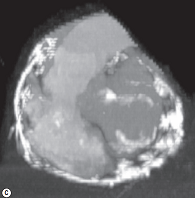 Constrictive pericarditis