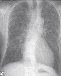 Cellular bronchiolitis