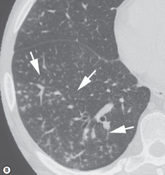Cellular bronchiolitis