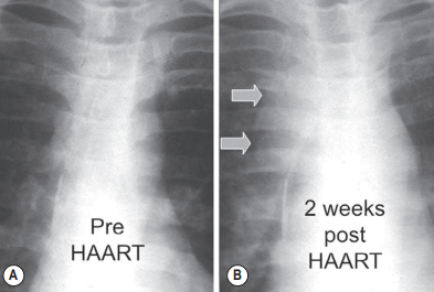 Immune reconstitution inflammatory syndrome