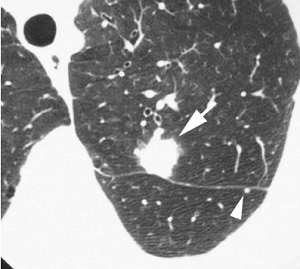 Hilar and mediastinal lymph nodes are frequently enlarged