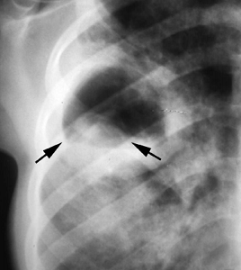 Ruptured hydatid cyst