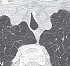 Post-intubation tracheal stenosis in a severe COPD patient.
