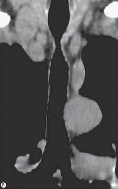 Post-intubation tracheal stenosis in a severe COPD patient.