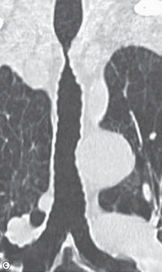 Post-intubation tracheal stenosis in a severe COPD patient.