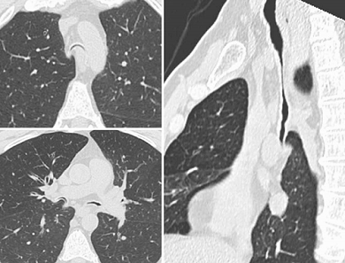 Almost complete collapse of the trachea, (left) mainstem and (right) intermediate bronchi lumen.