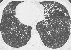 Dyskinetic cilia syndrome
