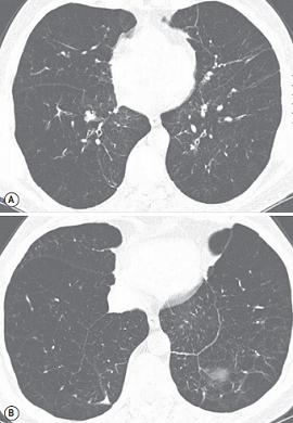 Panlobular emphysema in a patient with α1-antitryspin deficiency