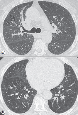 COPD patient with airway disease predominant phenotype