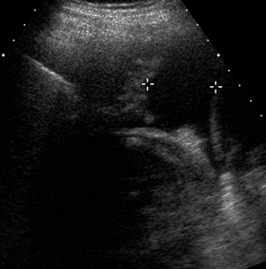 Ultrasound demonstrating a linear collapsed lower lobe