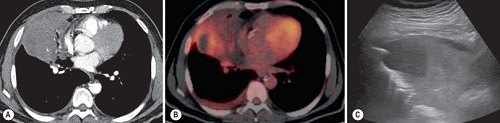 Intravenous contrast-enhanced CT demonstrating right middle lobe collapse