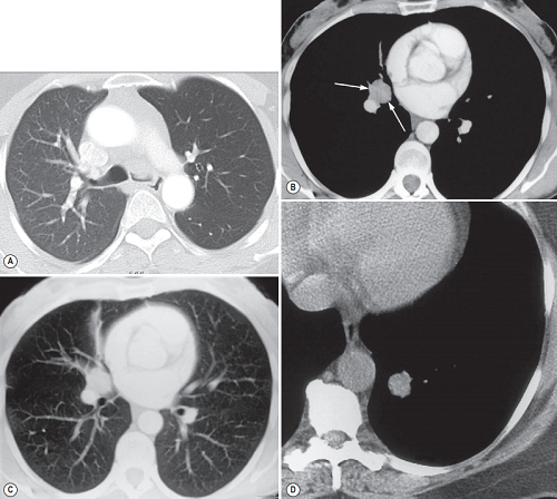 A tumour is partially occluding the left main bronchus.