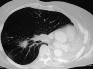 CT demonstrating a second primary bronchogenic carcinoma in the right lung