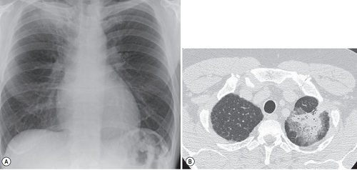 Lung cancer mimicking pneumonia